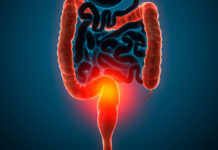 Рак ободочной кишки