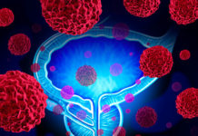 Рак предстательной железы