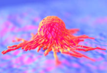 Распространенный колоректальный рак