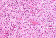 Семинома яичка