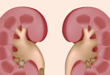 Мочекаменная болезнь