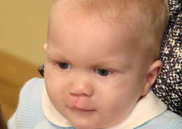 Врачи подарили Саше новое лицо