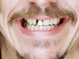 Клиновидная угроза для зубов