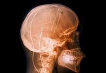 Синдром Туретта. Ответы на вопросы