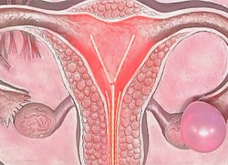 Апоплексия яичника