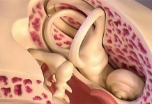 Отосклероз: причина потери слуха