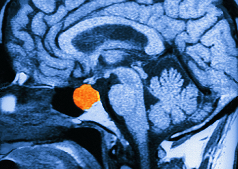 Опухоли гипофиза: факторы риска и осложнения