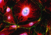 Листовидная цистосаркома