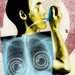 Аллергические заболевания легких