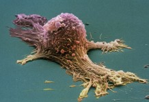 Рак яичников