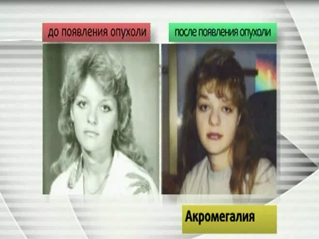 Клинические проявления опухоли гипофиза:. Аденома гипофиза симптомы. Лекарство при микроаденоме гипофиза. Препарат при аденоме гипофиза. Нарушение гипофиза болезни.