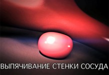 Аневризма сосуда головного мозга