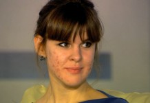 Лечение прыщей