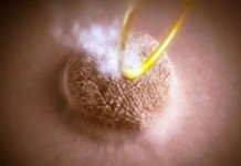 Красота за 5 минут. Удаление бородавок на лице