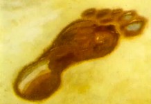 Плоскостопие у детей