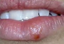 Что такое герпес