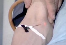 Лазер против герпесвирусной инфекции