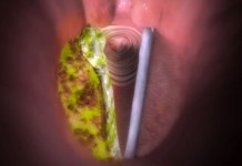 Программа «Здоровье» от 15 июня 2014 г.