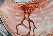 Язвенная болезнь желудка