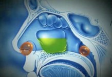 Новый метод лечения гайморита