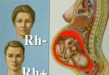 Отрицательный резус-фактор