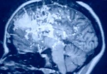 Рассеянный склероз: что это такое