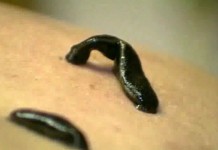 Второе пришествие пиявок в медицину