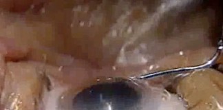 Новый метод лечения катаракты