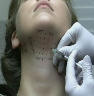 Достижение медицины. Избавление от второго подбородка