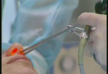 Лазерное исправление носовой перегородки