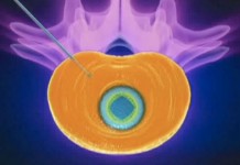 Удаление грыжи межпозвоночного диска