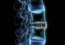 Замена межпозвоночного диска