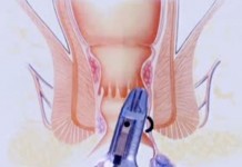 Лечение геморроя