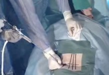 Эндоскопическое удаление грыжи позвоночника