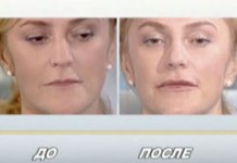 Липофилинг губ