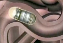 Капсульная эндоскопия