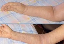 Как избавиться от лимфостаза