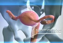 Опущение матки