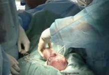 Удаление миомы матки во время беременности