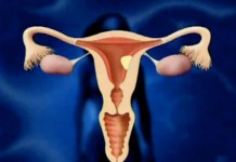 Новый метод лечения миомы матки