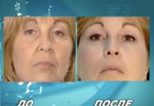 Как быстро избавиться от морщин