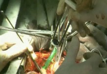 Протезирование клапанов сердца (1 часть)