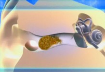 Как решить проблему серных пробок