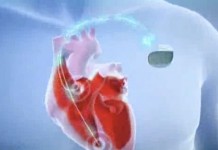 Имплантация кардиосинхронизирующей системы