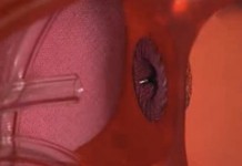 Новая технология лечения пороков сердца