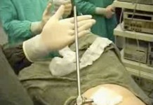 Лапароскопическая стерилизация