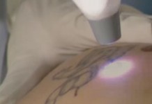 Лазерное удаление татуировок