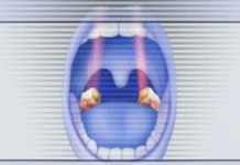 Лечение тонзиллита лазером