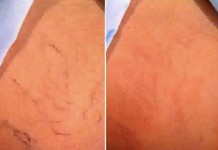 Лазер против сосудистой сеточки на ногах