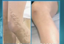 Удаление вен через проколы